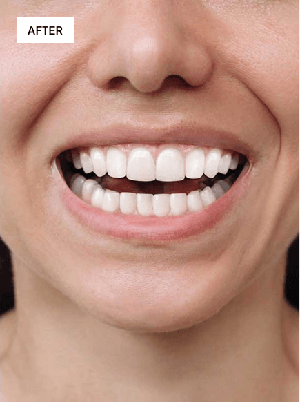After aligner treatment smile result