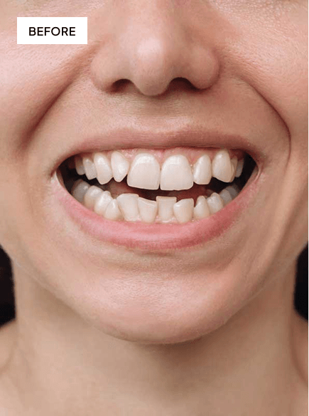 Before aligner treatment smile result